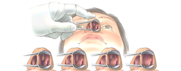 Clasificación endoscópica de la hipertrofia del cornete inferior