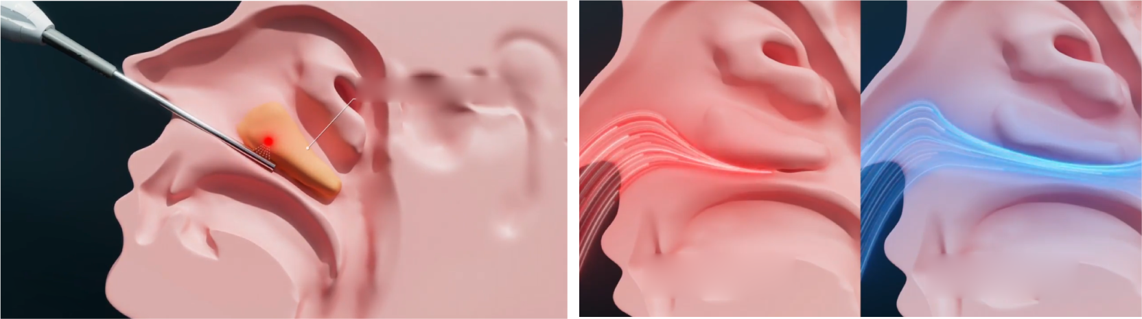Tratamiento con HIFU del cornete inferior y flujo de aire nasal antes y después del tratamiento