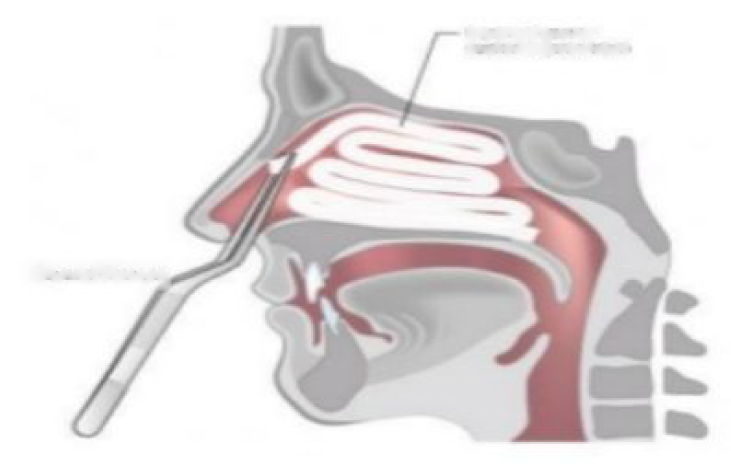 Taponamiento nasal colocado después de la cirugía