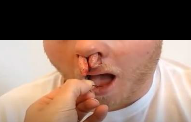 Paciente con taponamiento nasal